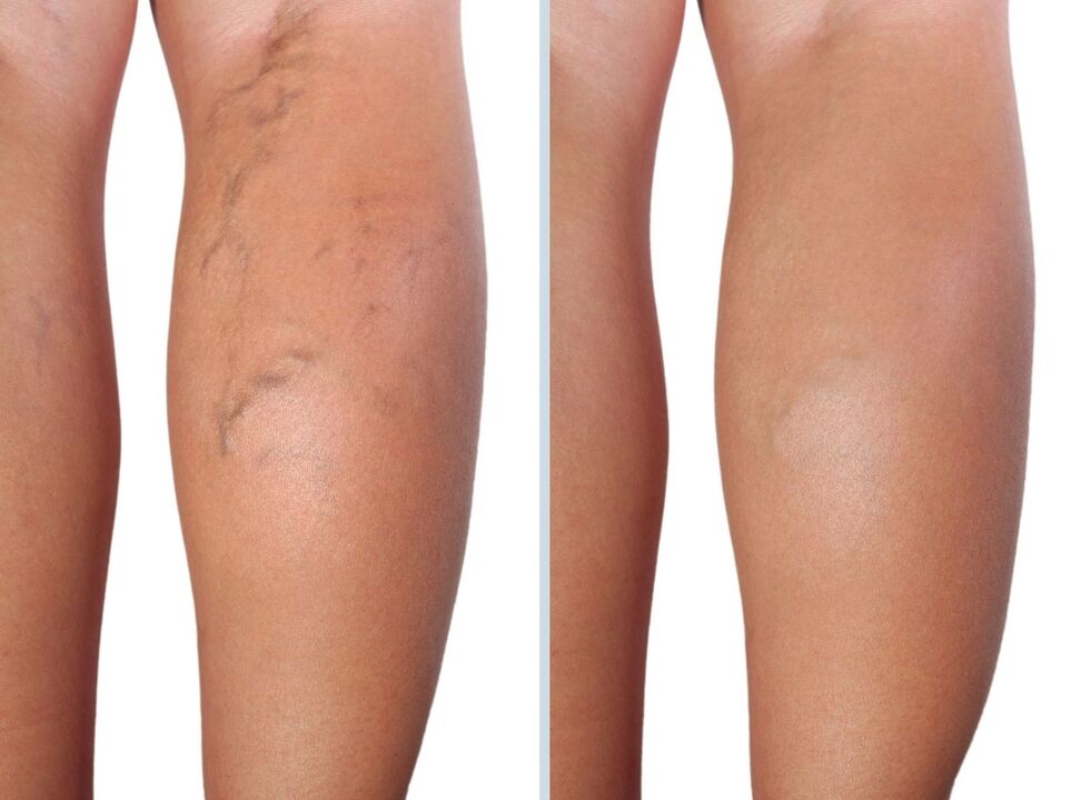 My experience in applying for a neuveris gel