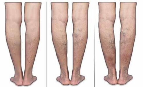 Varicose vein stage