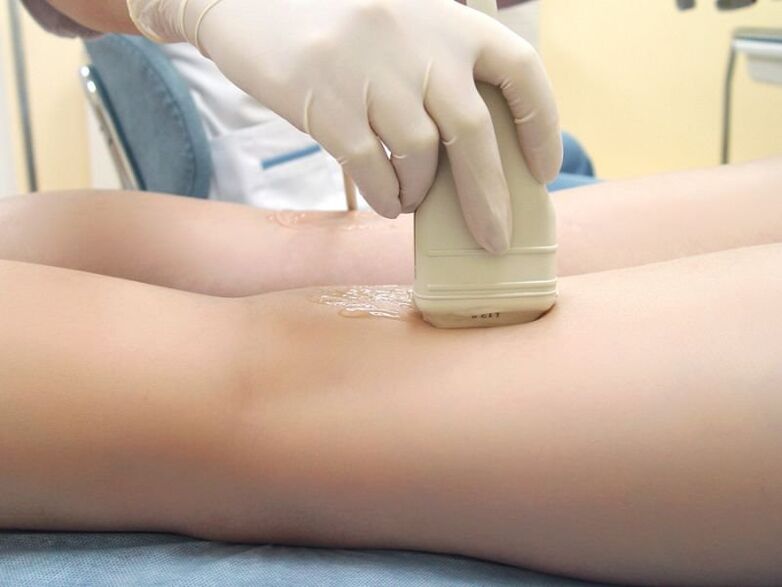 Varicose vein treatment