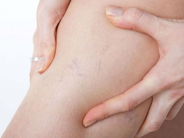 varicose veins on the feet
