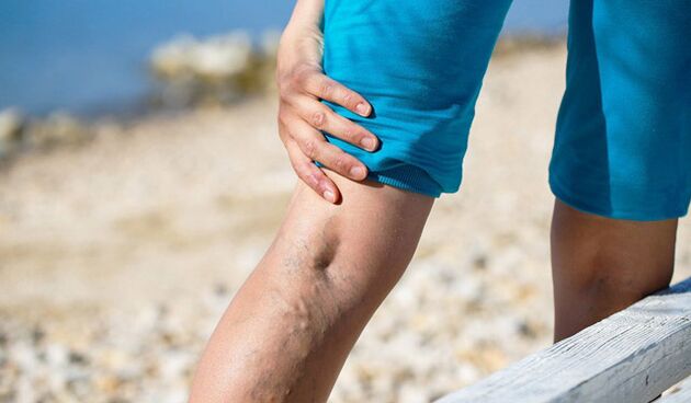 Varicose veins