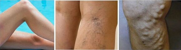 The appearance of varicose veins on the feet