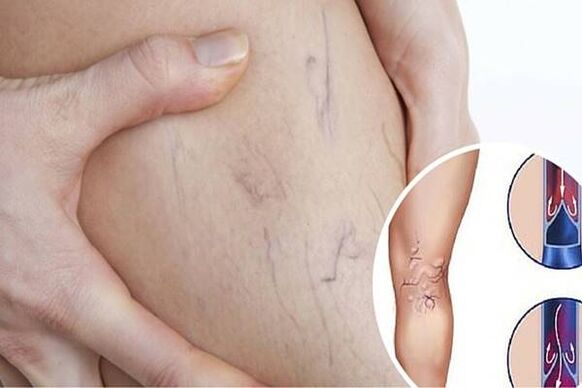 Photos of varicose veins