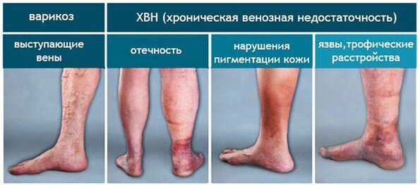 Varicose vein stage