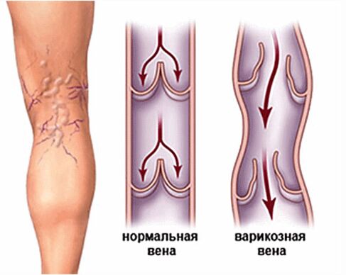 varicose veins