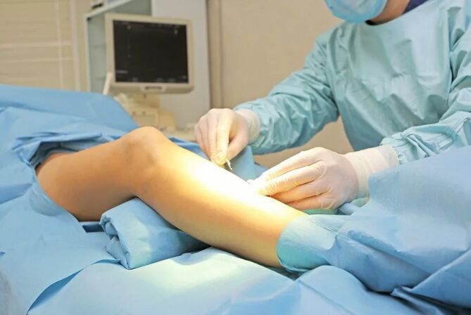 Operation for removal of veins on the foot