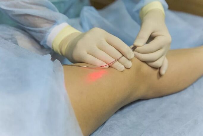 Varicose vein treatment with laser