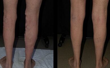 Treatment of varicose veins with laser photos before and after