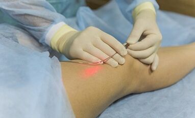 Varicose vein treatment with laser