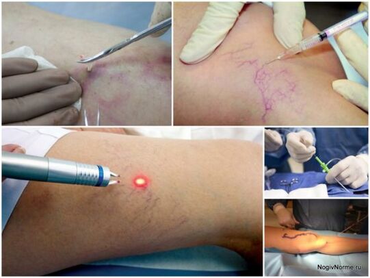 The type of treatment