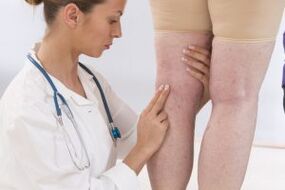 Phlebologists study patients with varicose veins