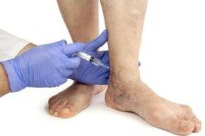 Sclerotherapy