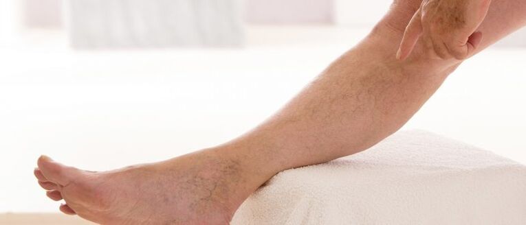 Varicose veins on the feet