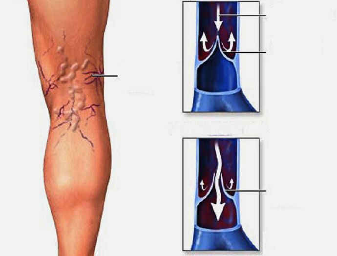 What are varicose veins like