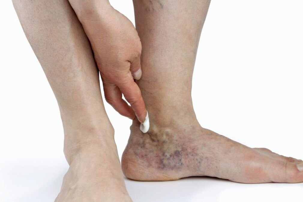 Varicose veins from the lower legs